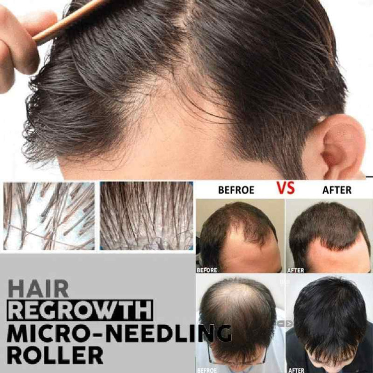 درما رولر NEEDLES 540 ماساژ زیبایی صورت تیتانیومی ۵۴۰ میکرو سوزن